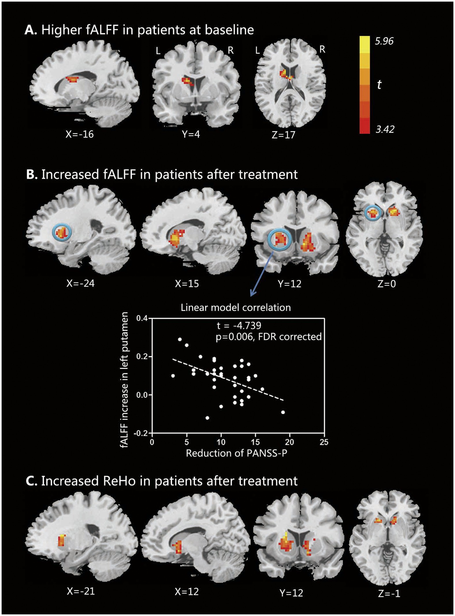 Short-term Effects of Risperidone Monotherapy on Spontaneous Brain Activity  in First-episode Treatment-naïve Schizophrenia Patients: A Longitudinal  fMRI Study | Scientific Reports