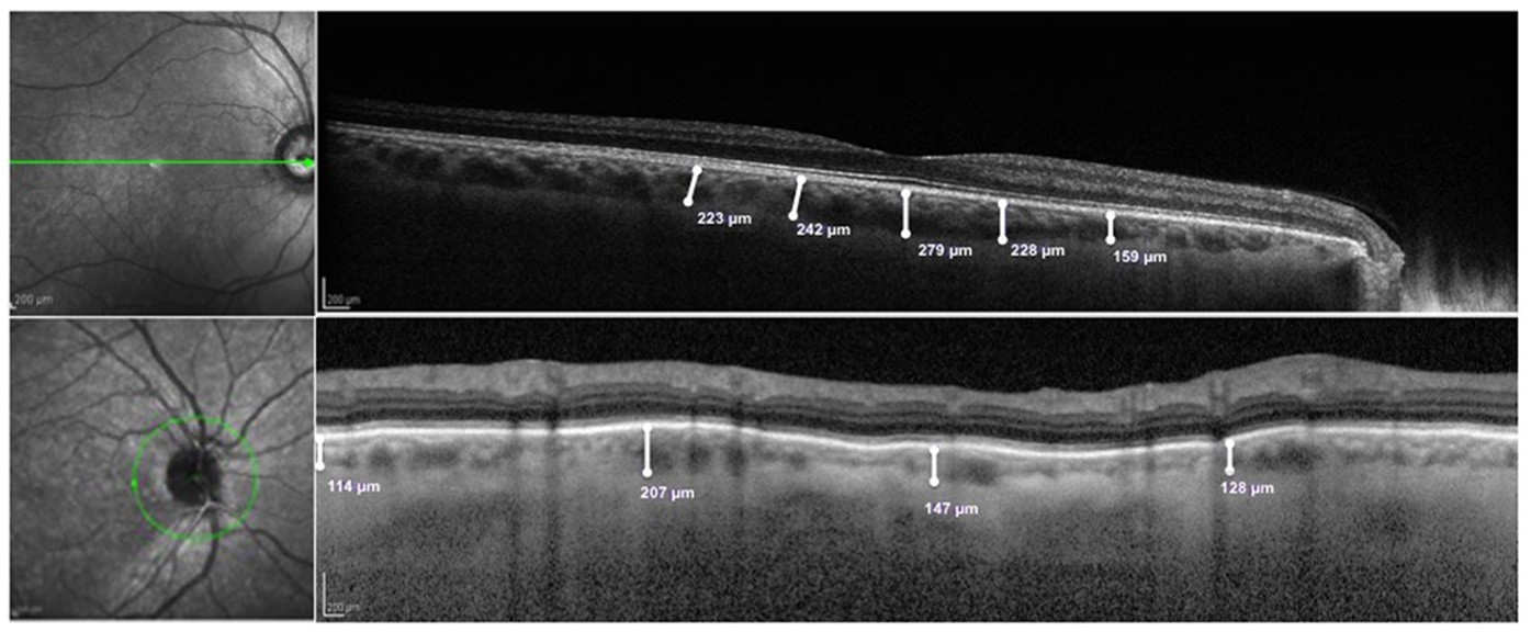 Changes in Choroidal Thickness follow the RNFL Changes in Leber's  Hereditary Optic Neuropathy | Scientific Reports