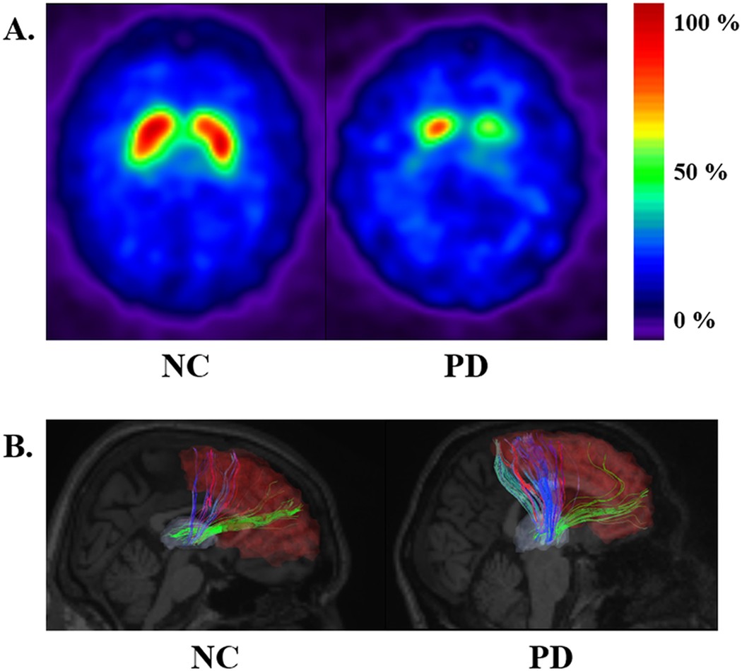 fMRI vs. SPECT Scan for the Brain