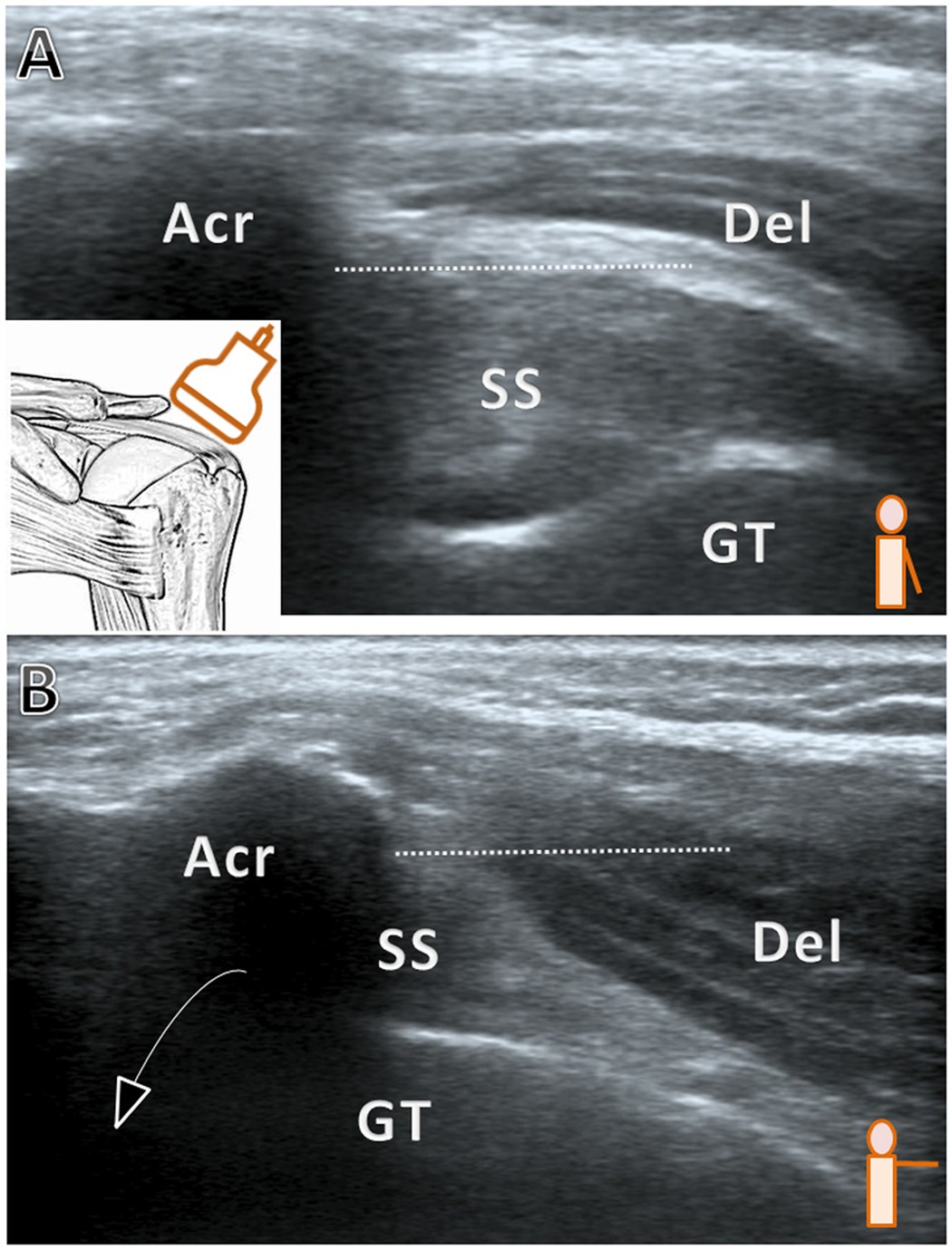 Association of Bicipital Peritendinous Effusion with Subacromial  Impingement: A Dynamic Ultrasonographic Study of 337 Shoulders | Scientific  Reports