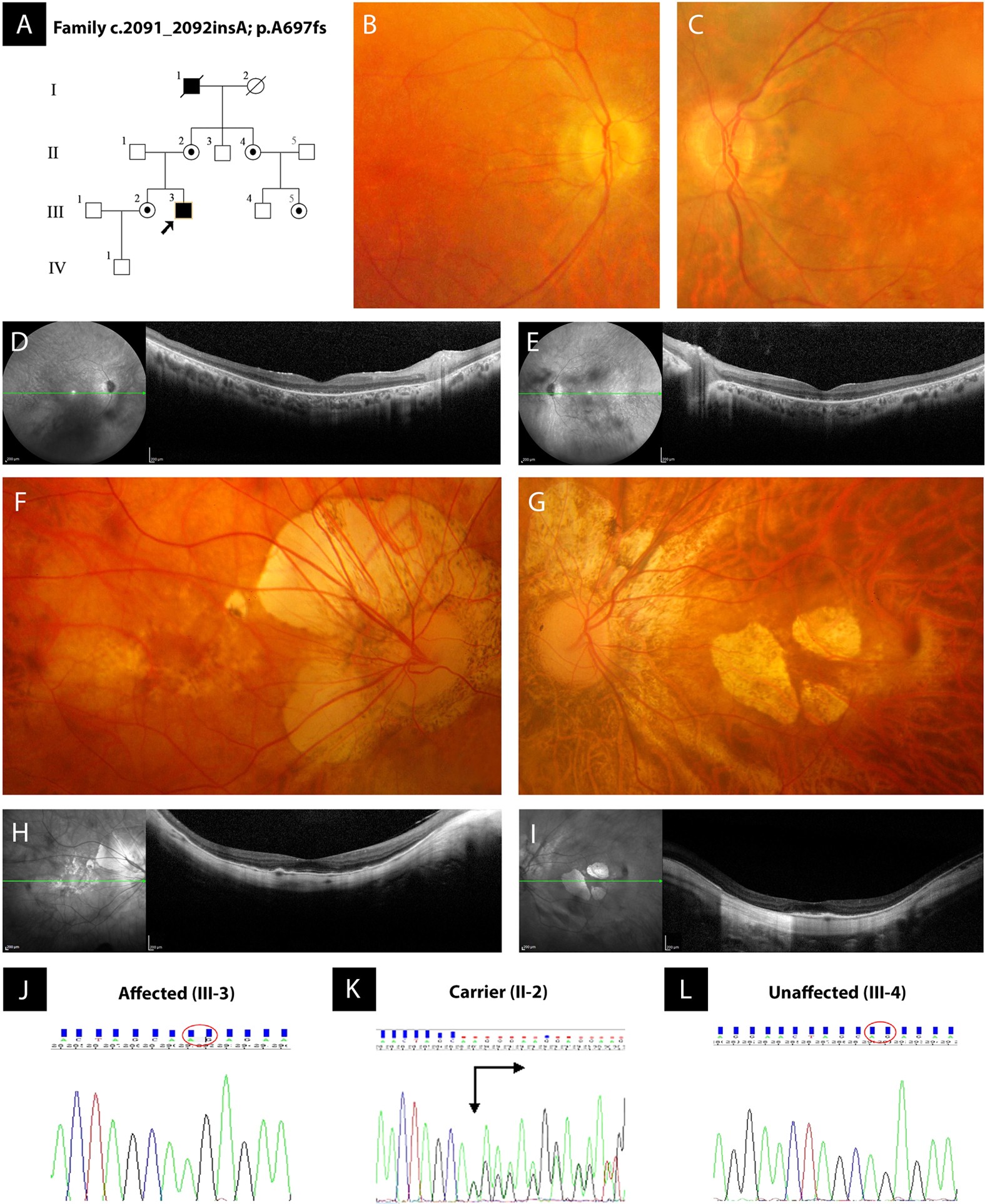Identification of novel X-linked gain-of-function RPGR-ORF15 mutation in  Italian family with retinitis pigmentosa and pathologic myopia | Scientific  Reports