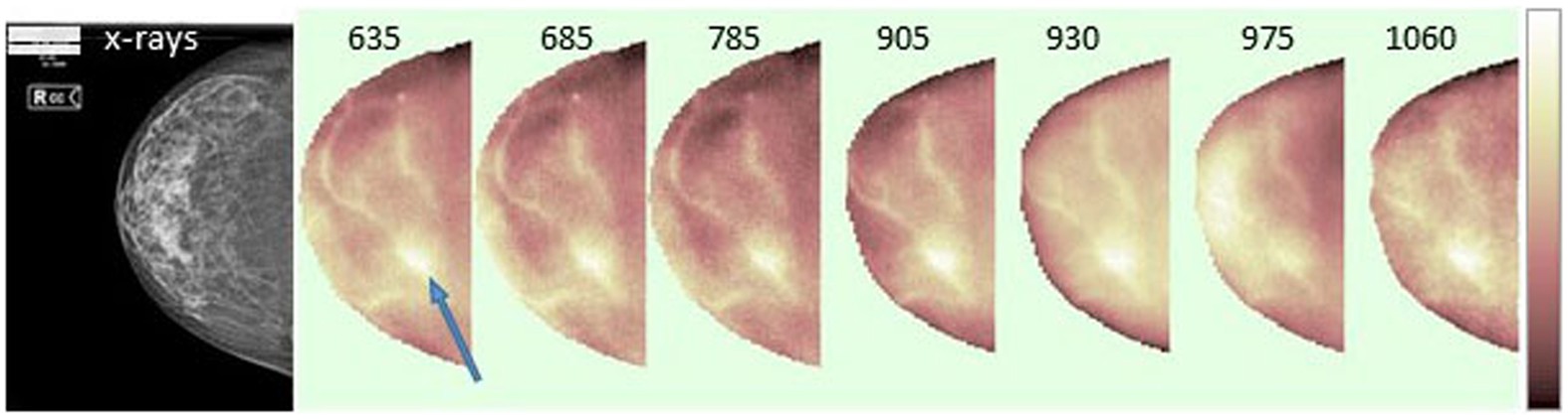 Breast Anatomy Types of Breast Tissues • Fibrous • Fibro glandular • Adipose  (Fatty) What is Tomosynthesis? • Is a 3 dimensional projection