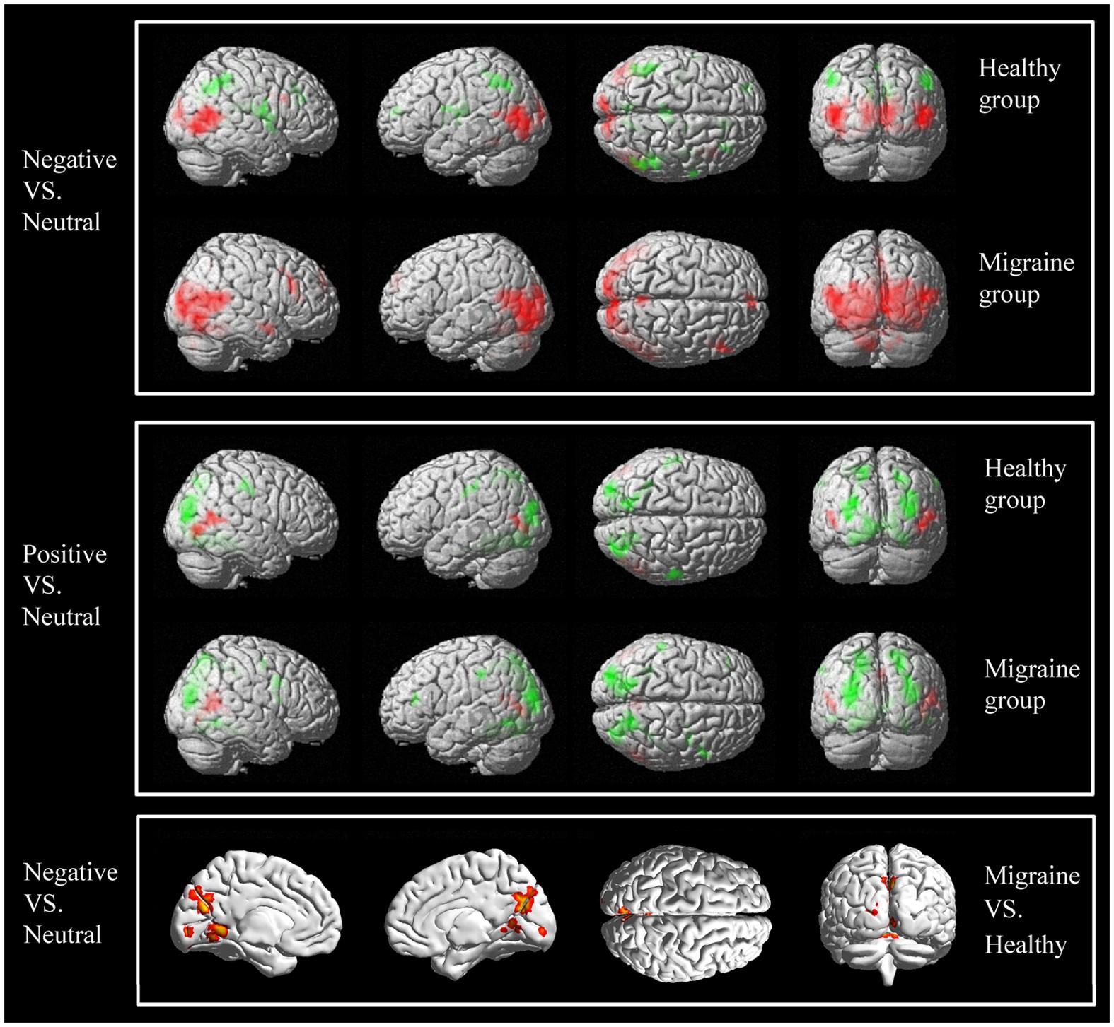 Visual Cortex And Cerebellum Hyperactivation During Negative Emotion Picture Stimuli In Migraine Patients Scientific Reports