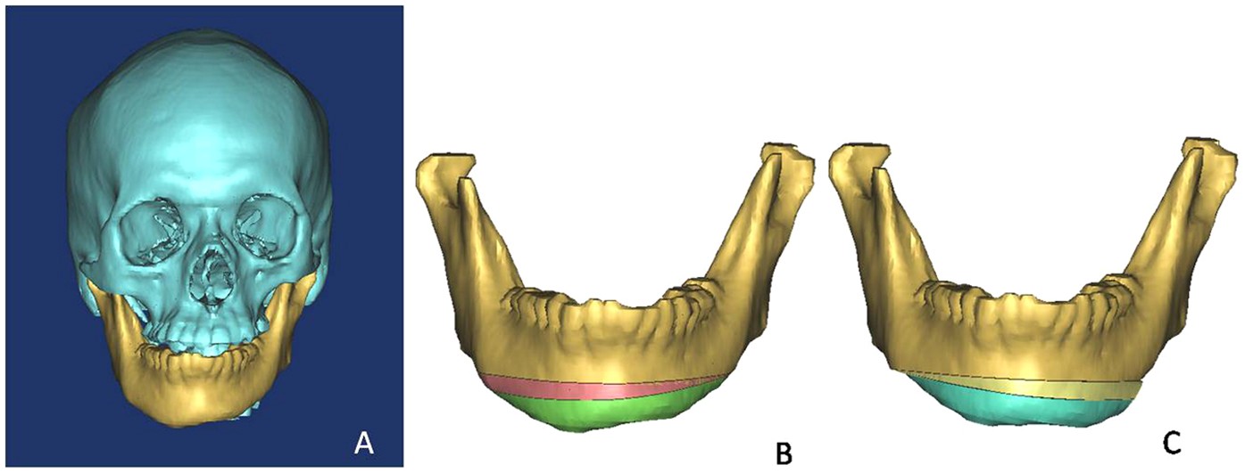Figure 8: Surgical plan with the 3D model of bony tissue.