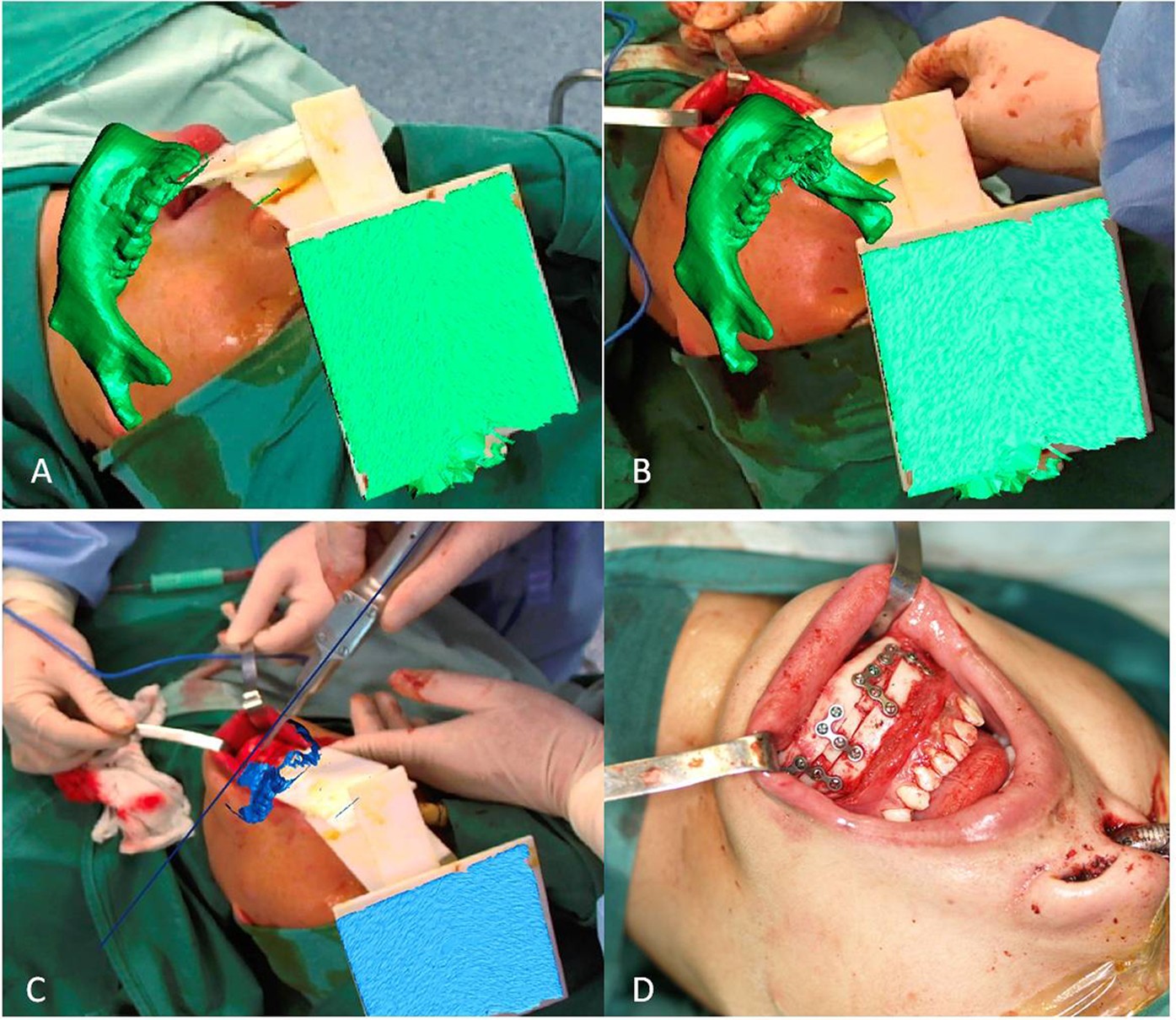 Figure 9: AR technique applied during surgery.