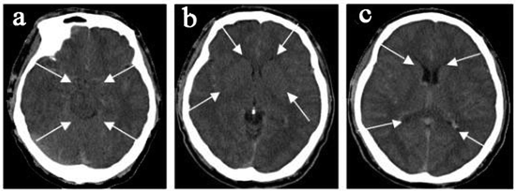 Figure 1: CMS patient, a 46-year-old male, hemoglobin 24.1 g/dl.
