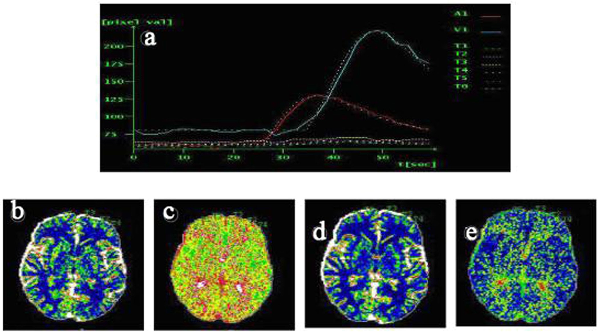Figure 5: CMS patient, 28-year-old male.
