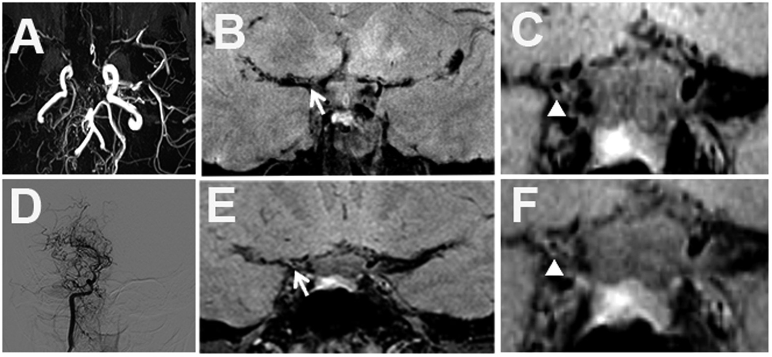 Nontraumatic intravasation of myelographic contrast medium