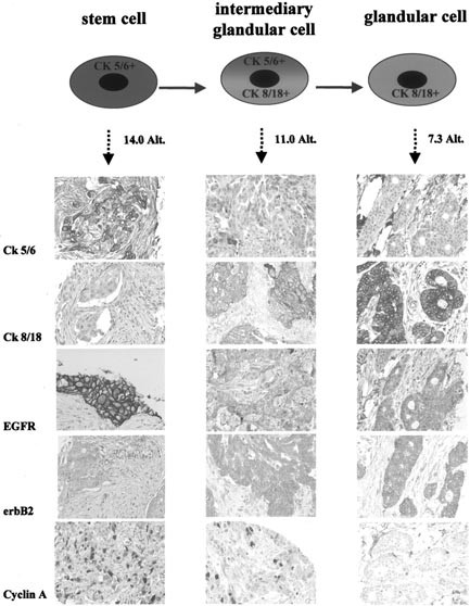 Cytogenetic Alterations And Cytokeratin Expression Patterns In Breast Cancer Integrating A New Model Of Breast Differentiation Into Cytogenetic Pathways Of Breast Carcinogenesis Laboratory Investigation Cytogenetic Alterations And Cytokeratin Expression Patterns In Breast Cancer Integrating A New Model Of Breast Differentiation Into Cytogenetic Pathways Of Breast Carcinogenesis Laboratory Investigation