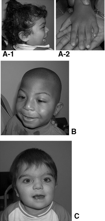 Clinical photos of the patients. (a) Case 1: Dysmorphic facial