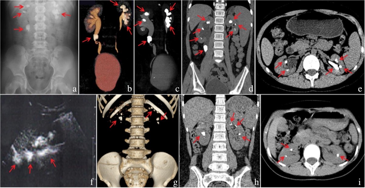 Mutational Analysis Of Agxt In Two Chinese Families With Primary Hyperoxaluria Type 1 Bmc Nephrology Full Text