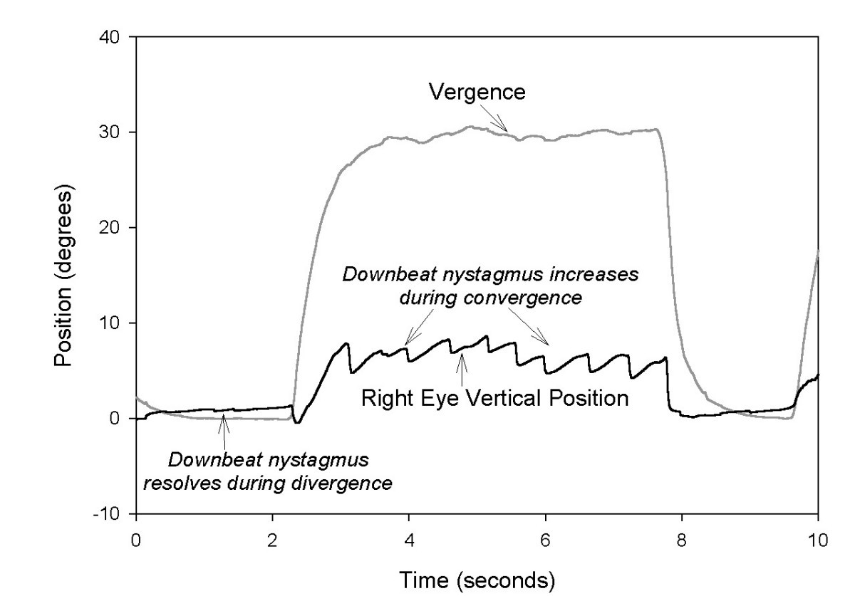 Nystagmus Nystagmus