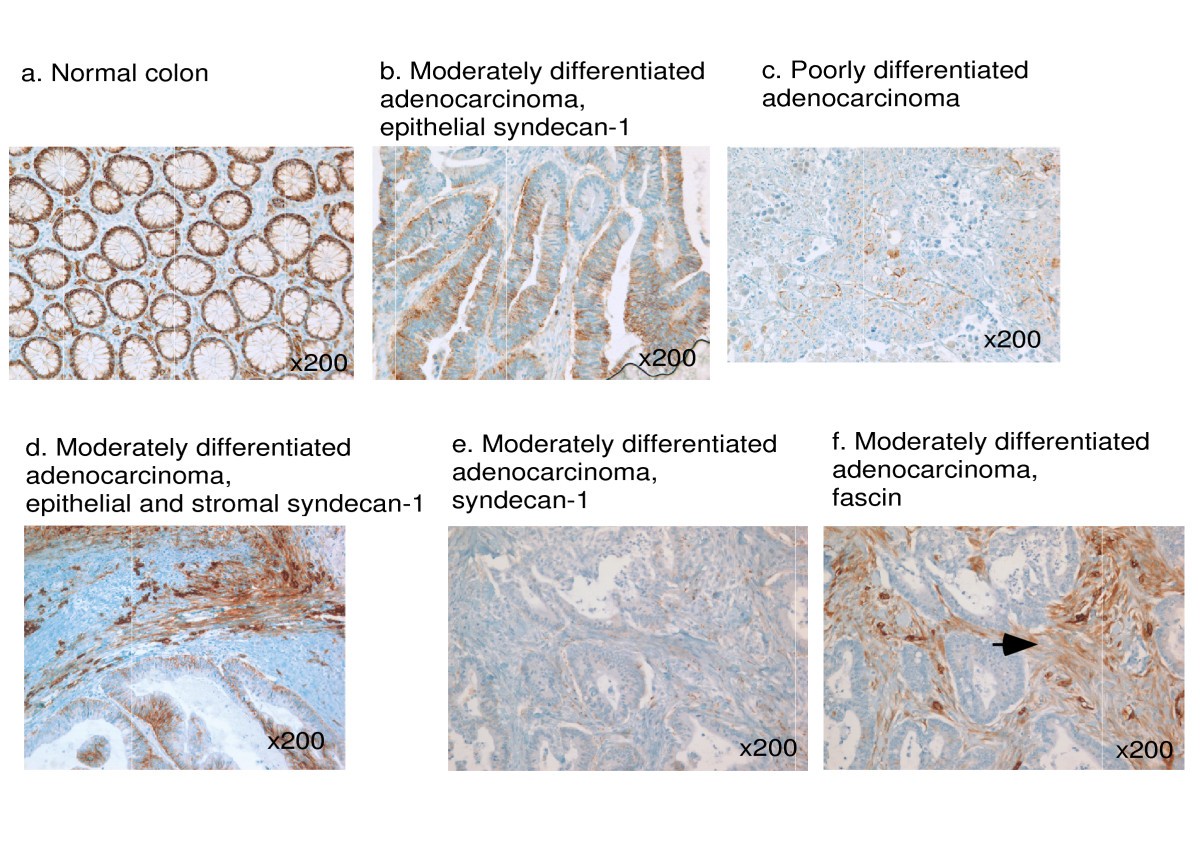 Ociation Of Loss Epithelial Syndecan 1 With Stage And Local Figure 1