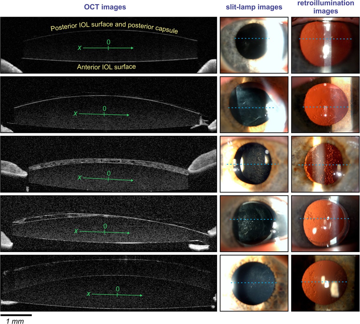 Optical coherence tomography for an invivo study of posteriorcapsule