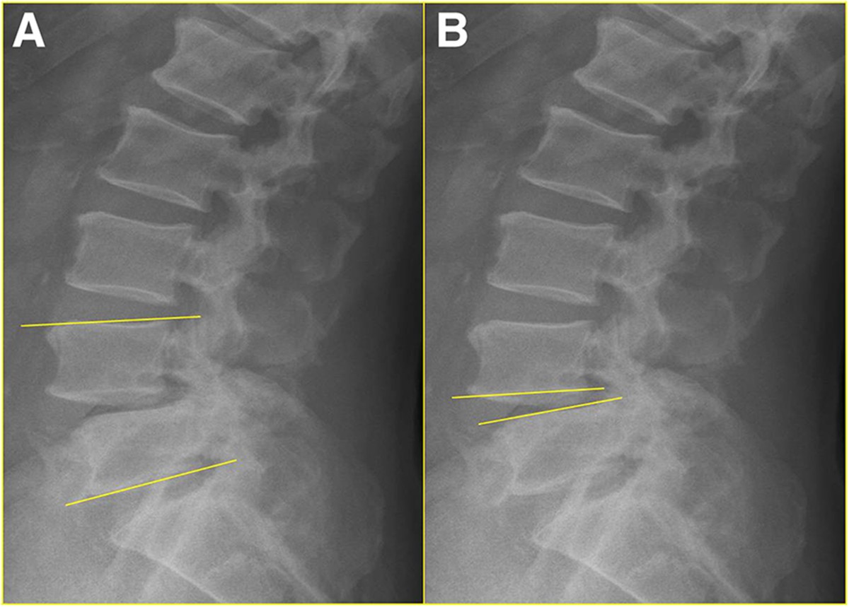 The effects of anterior vacuum disc on surgical of
