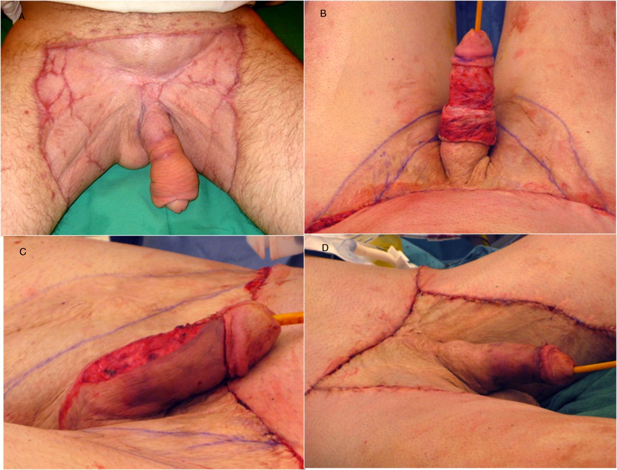 Management of unusual genital lymphedema complication after Fournier’s gang...