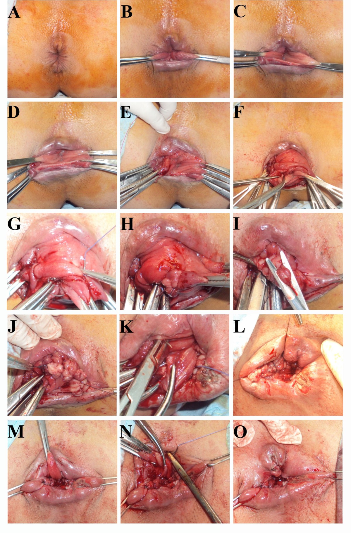 Figure 1. Longitudinal plication procedure for complete rectal prolapse man...