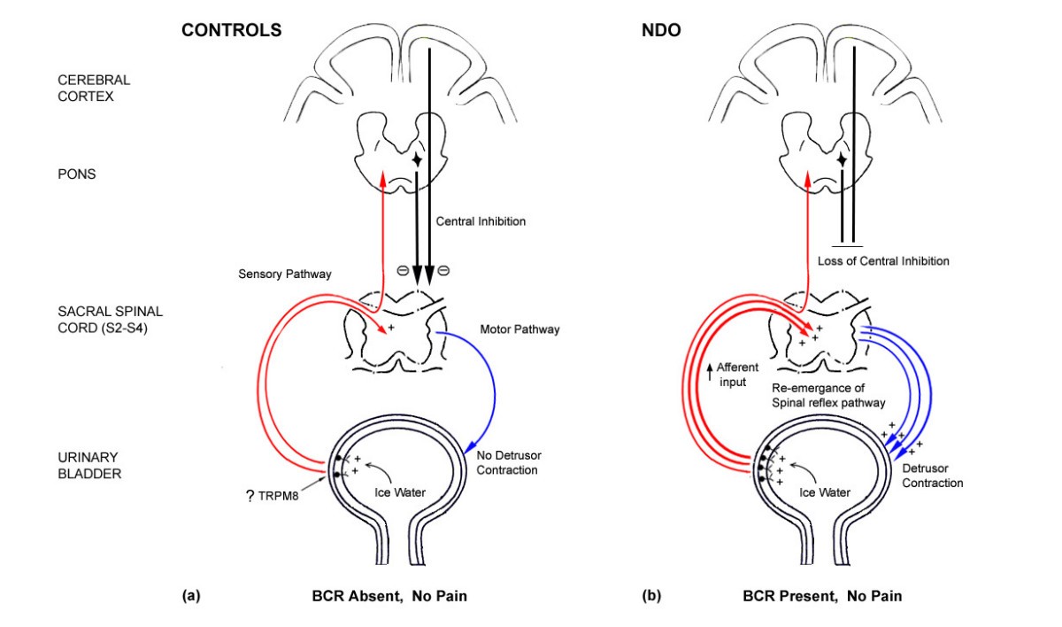 Pain during ice water test distinguishes clinical bladder hypersensitivity from overactivity