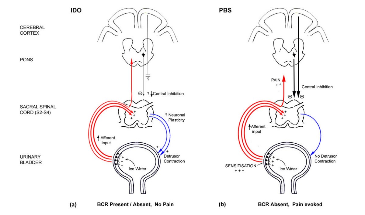 Pain during ice water test distinguishes clinical bladder ...