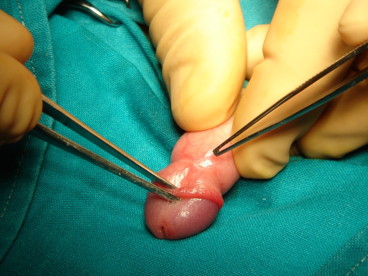 Figure 3 Sutureless prepuceplasty with wound healing by seco