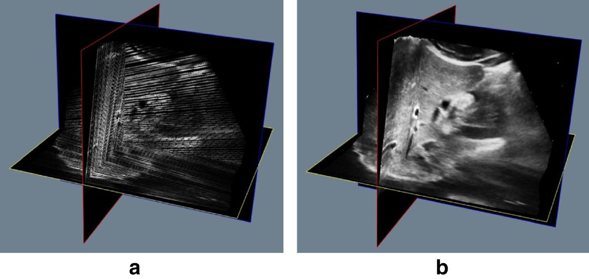 Reconstruction of freehand 3D ultrasound based on kernel regression
