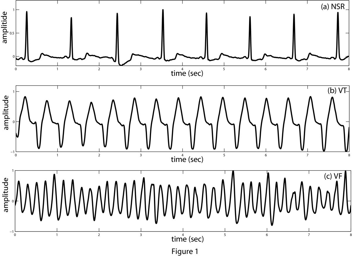 Sequential Algorithm For Life Threatening Cardiac Pathologies Detection Based On Mean Signal Strength And Emd Functions Biomedical Engineering Online Full Text