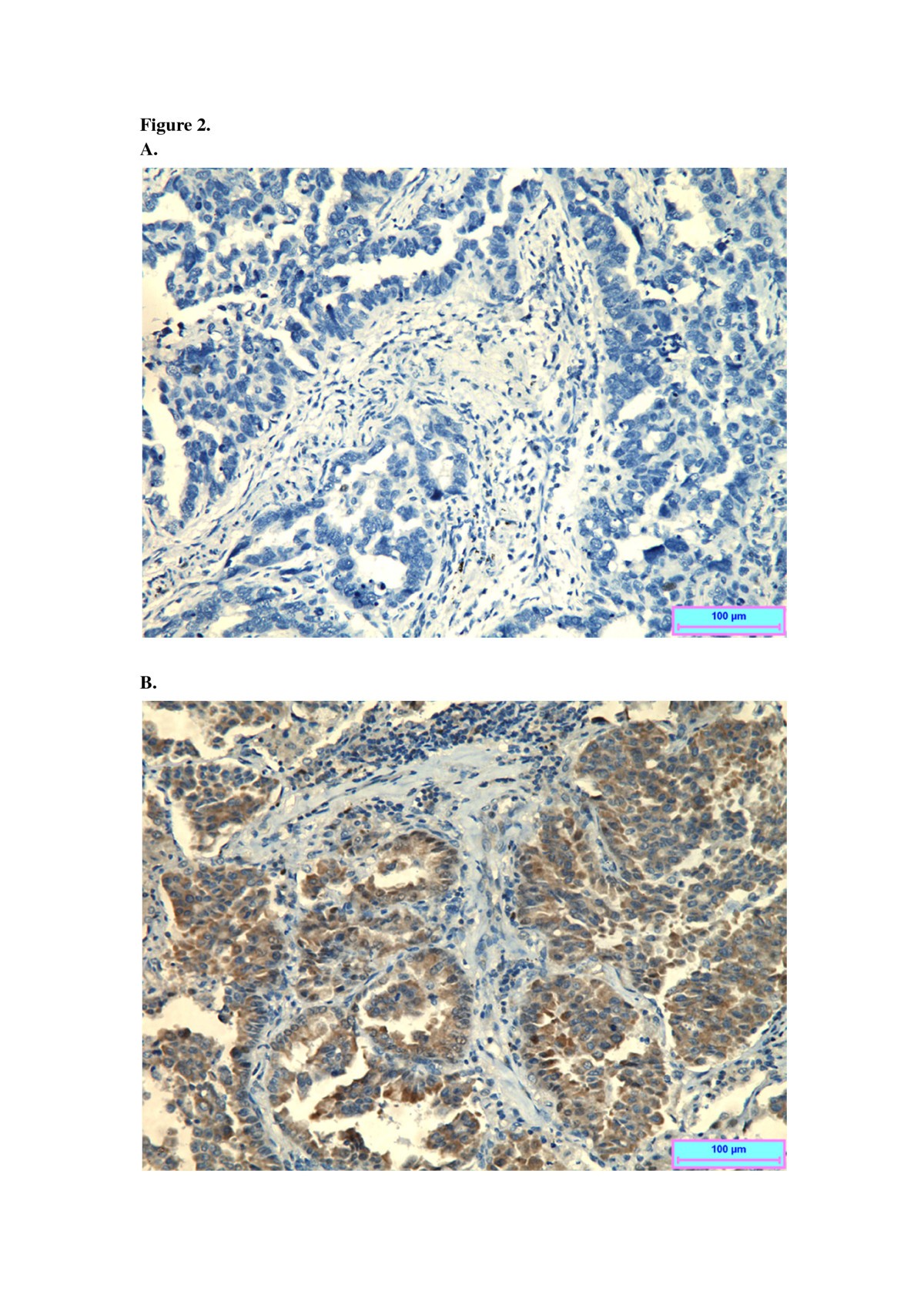 BCL11A Overexpression Predicts Survival And Relapse In Non Small