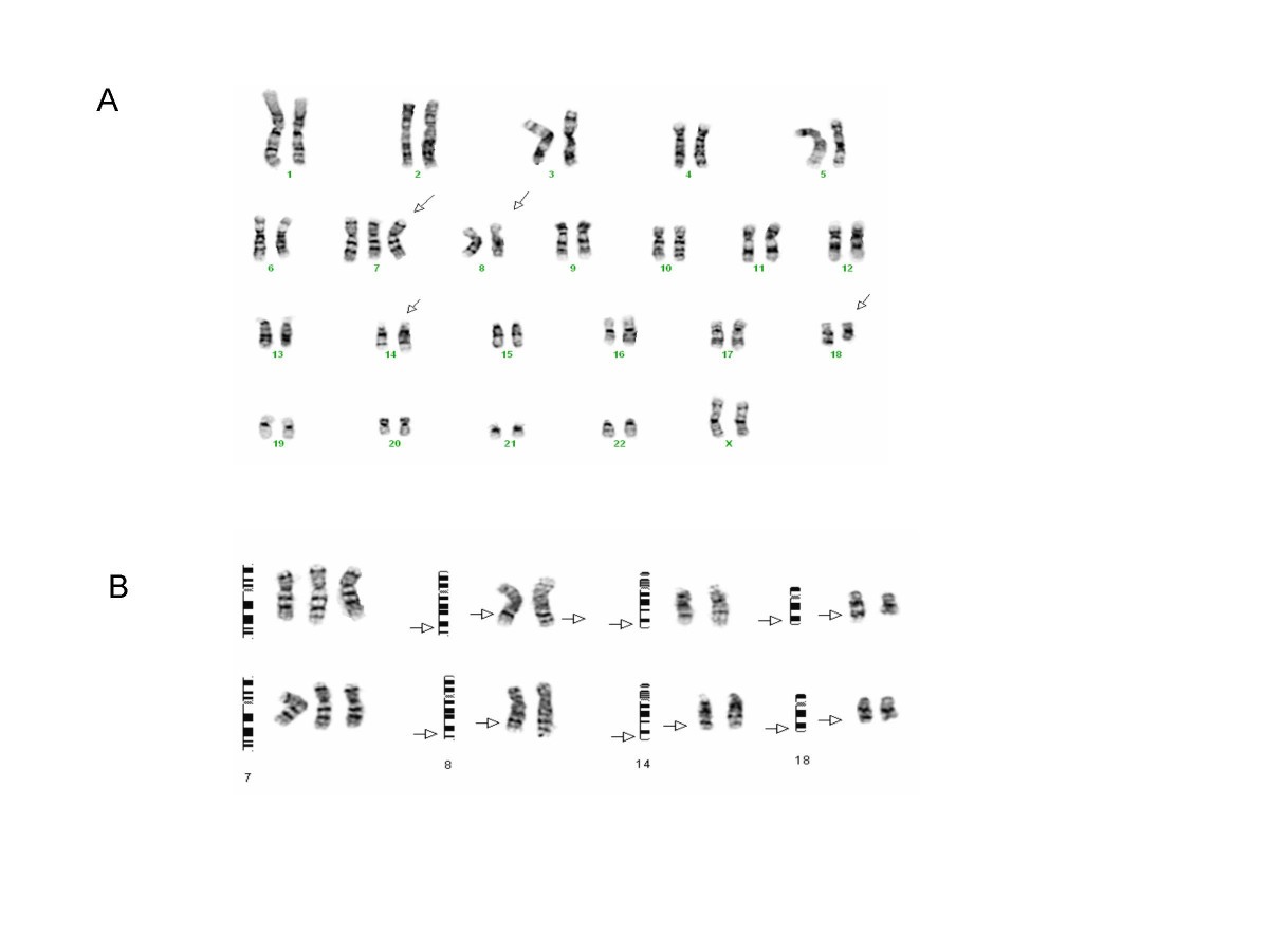 T 8 14 18 A 3 Way Chromosome Translocation In Two Patients With Burkitt S Lymphoma Leukemia Molecular Cancer Full Text