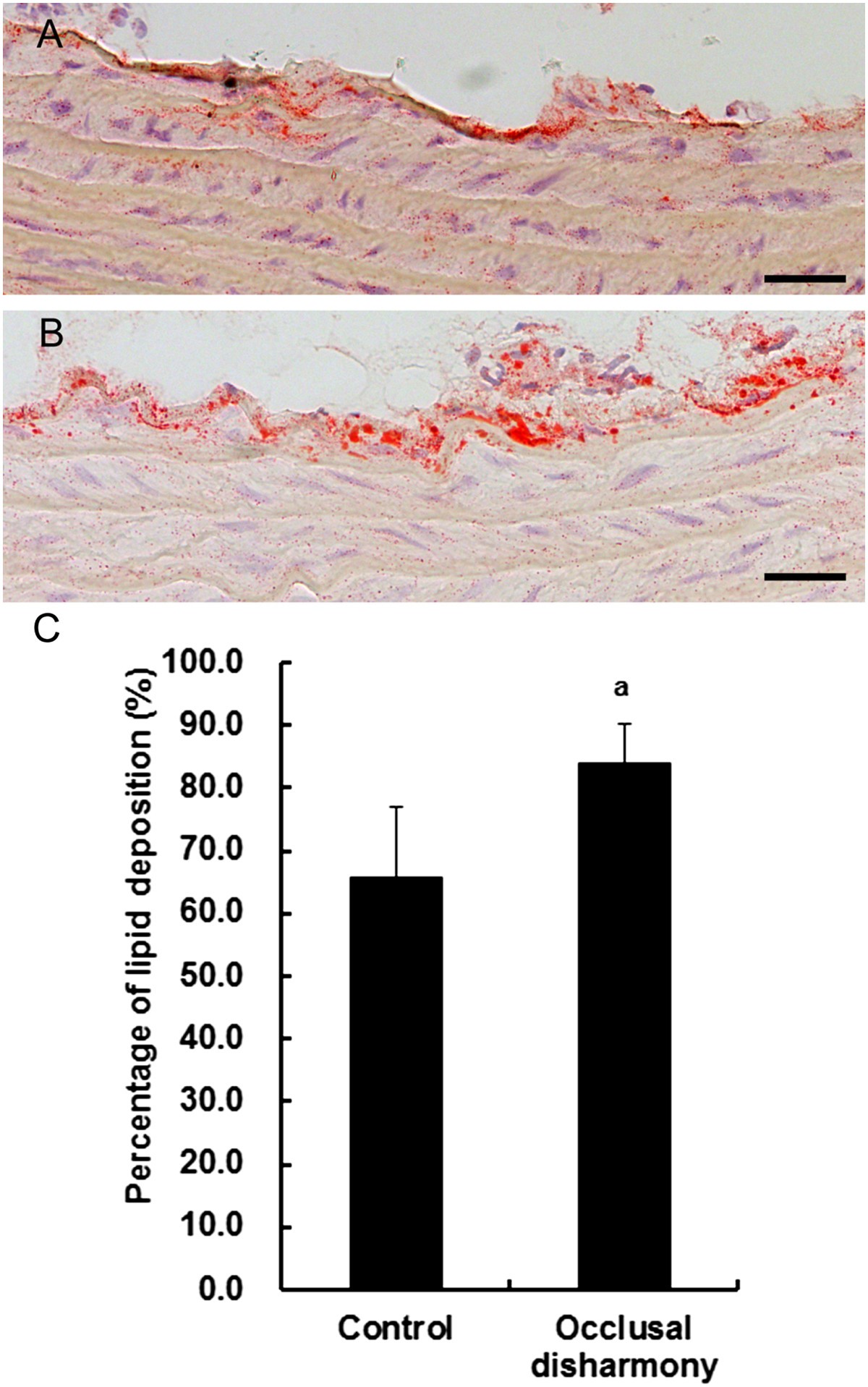 Occlusal disharmony accelerates the initiation of atherosclerosis in