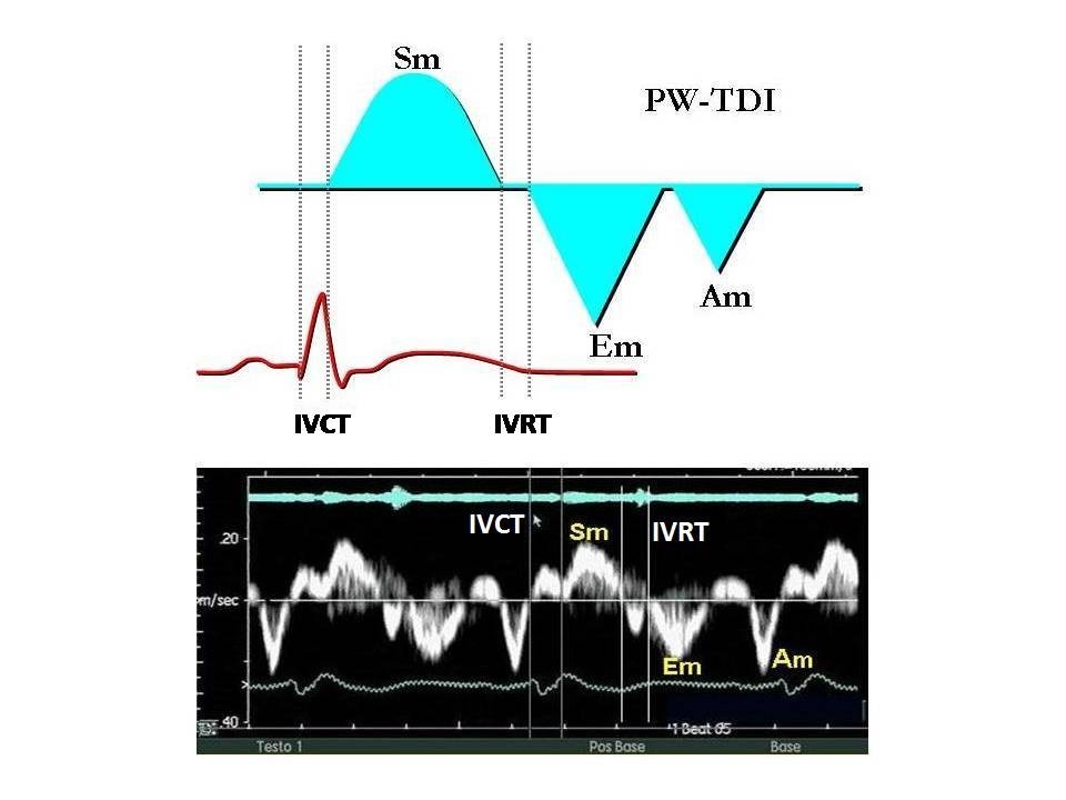 Tissue Doppler and strain imaging: anything left in the echo-lab? |  Cardiovascular Ultrasound | Full Text