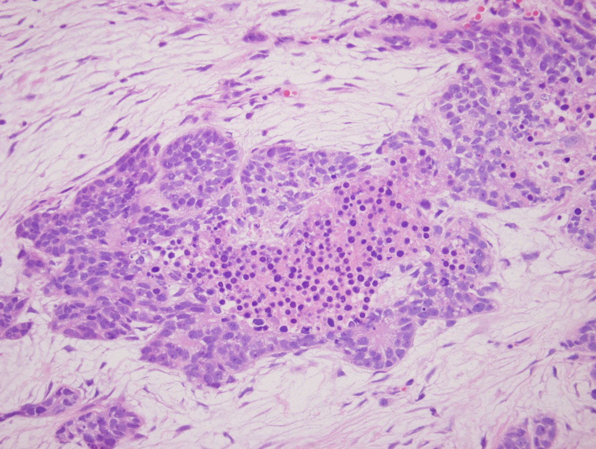 Basal Cell Carcinoma Of The Prostate Clinicopathologic Analysis