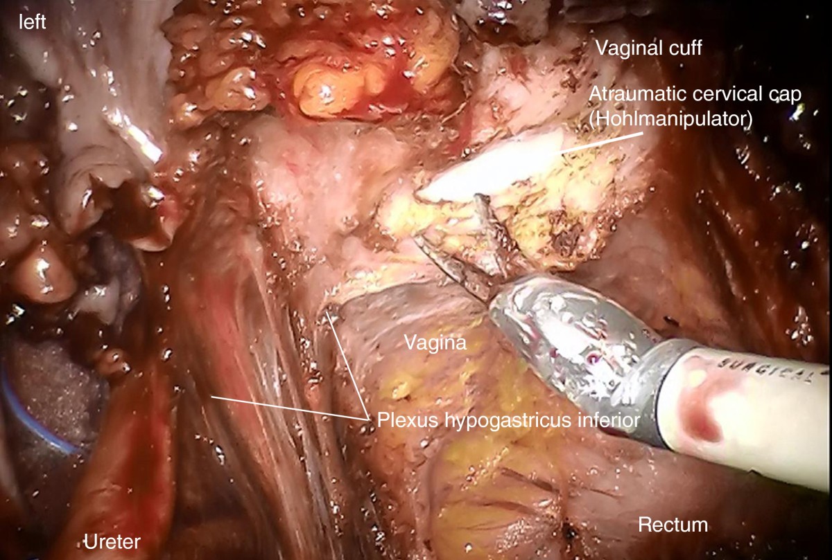 of the vaginal resection line and adequate preparation of the mesocolpium, ...