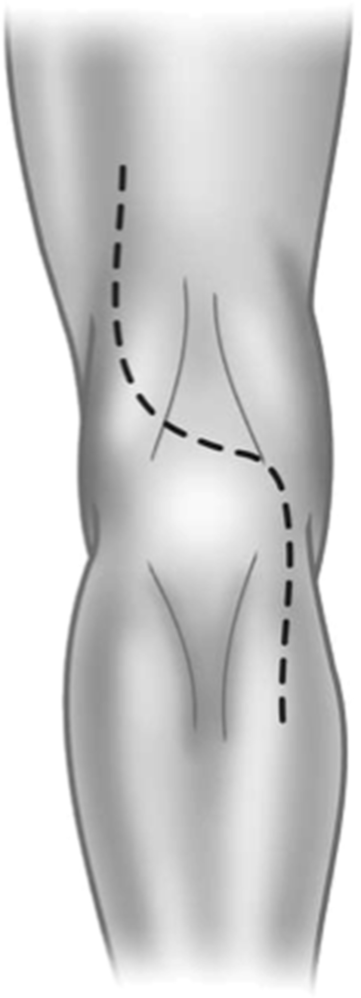 Popliteal lymph node dissection for metastases of cutaneous malignant