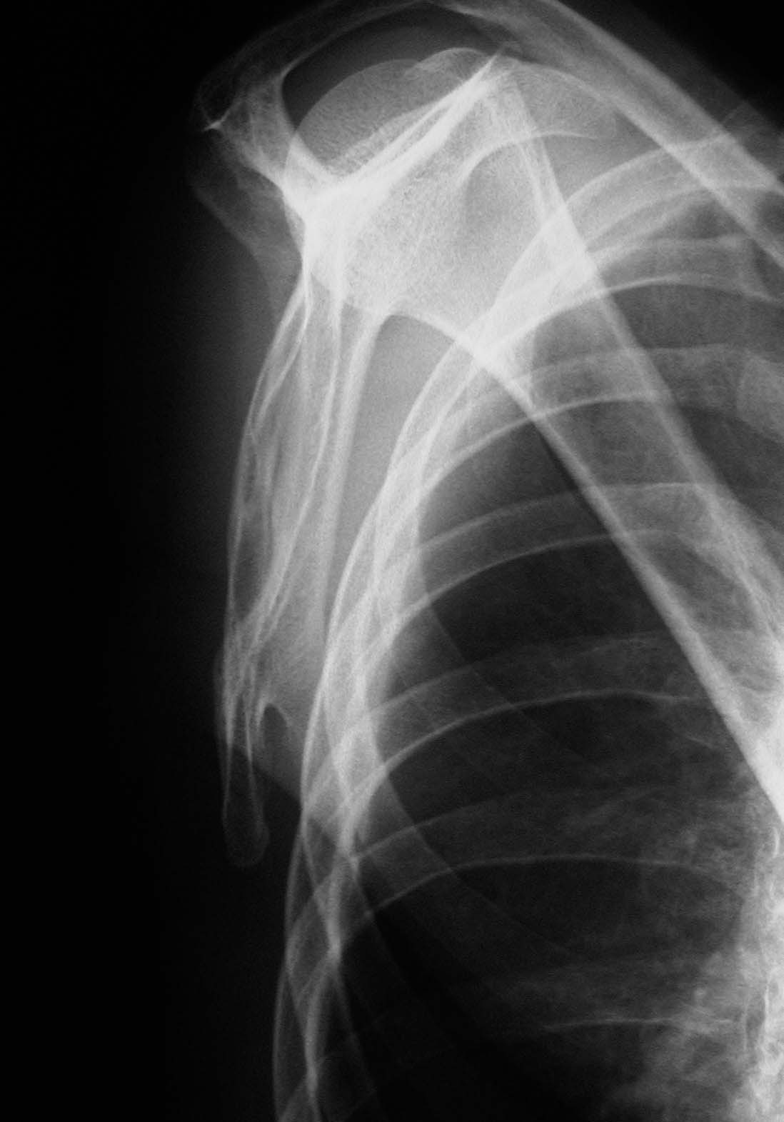 Endoscopically assisted resection of a scapular osteochondroma causing