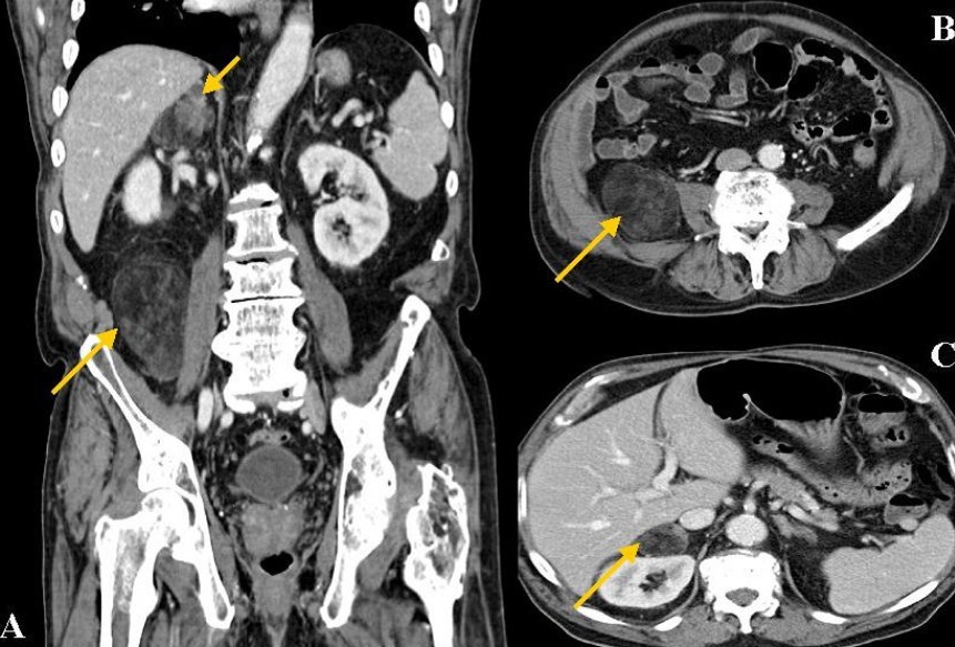 A: Coronal abdominal CT scan detected two