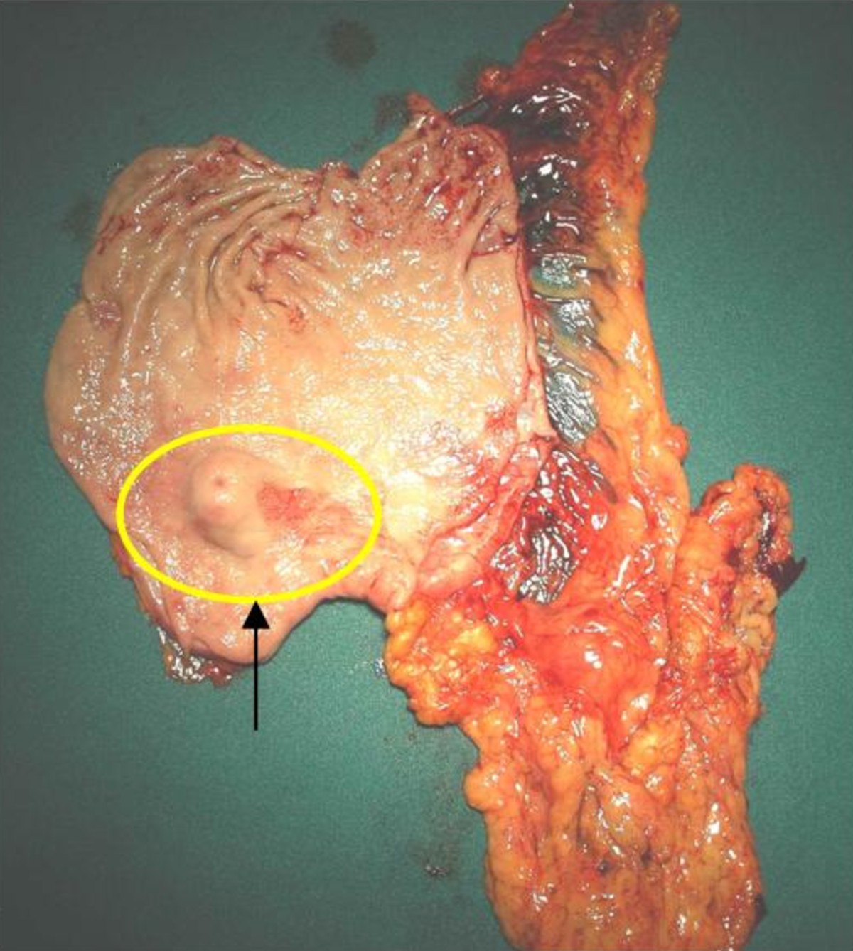 Gastric glomus tumor: A case report | World Journal of Surgical
