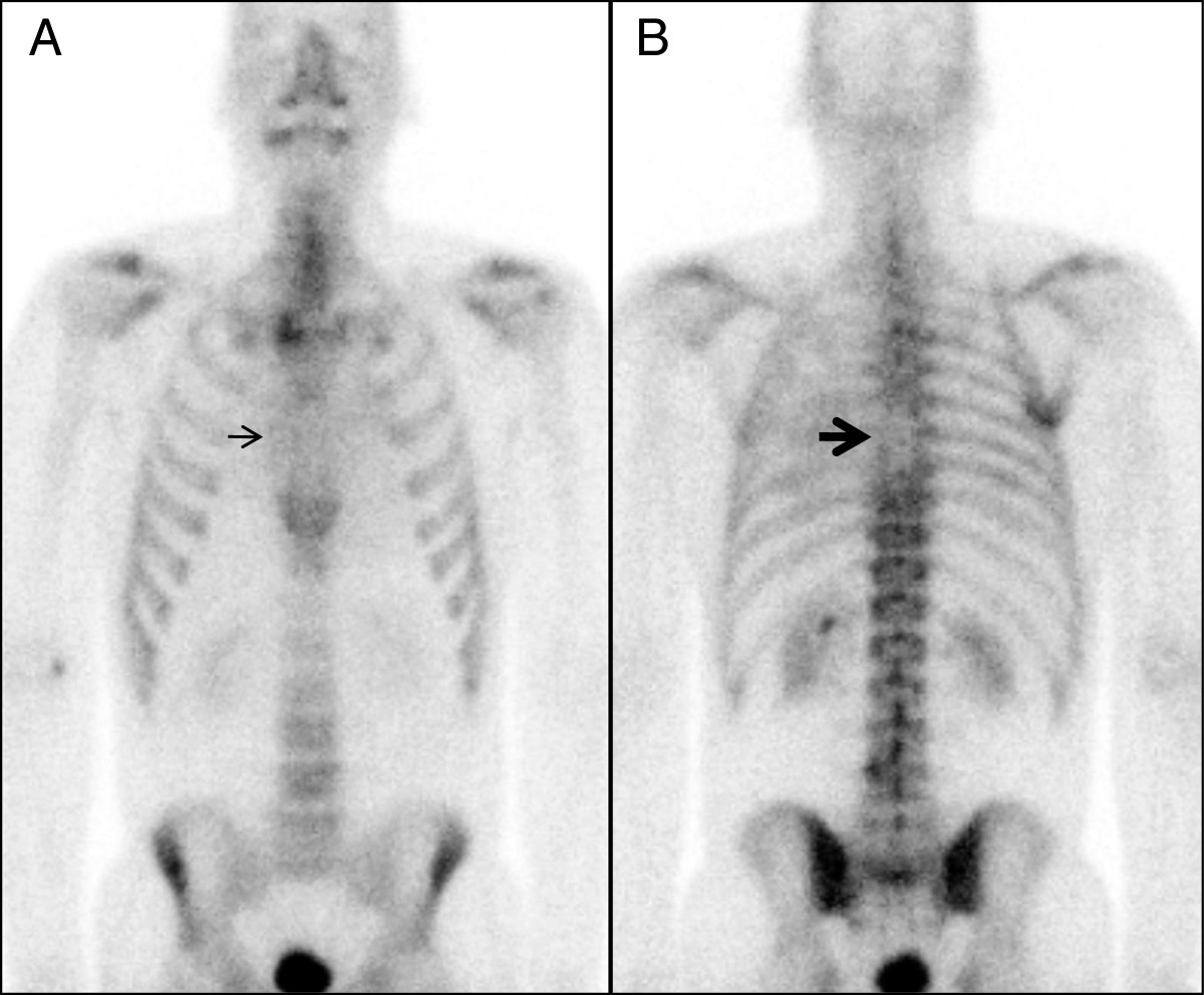Radiation recall reaction causing cardiotoxicity Journal of