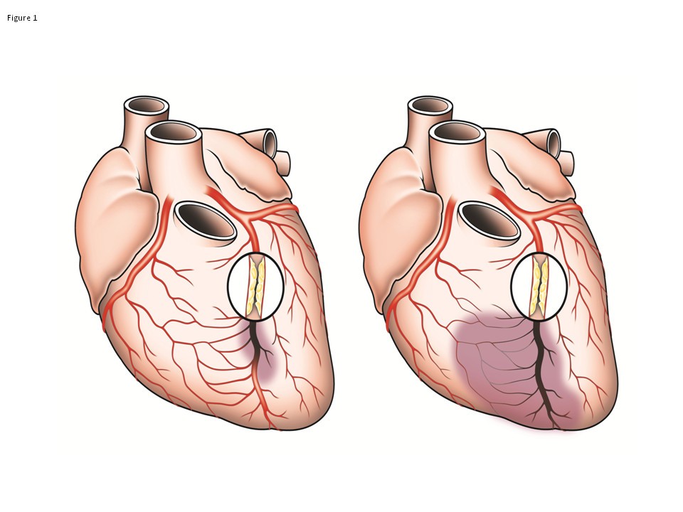 Coronary Collateral Circulation And Humans Are Often