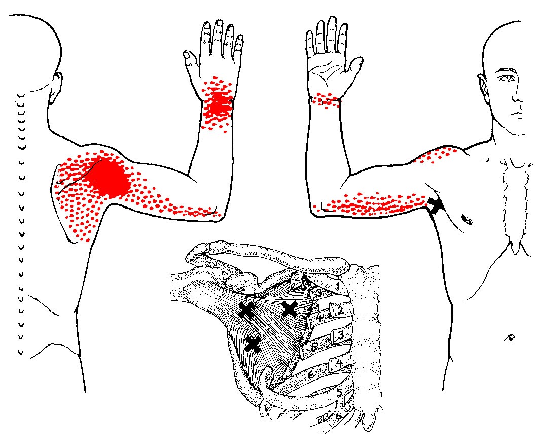 Болит под правой мышкой. Триггерные точки спины и отраженная боль. Боль в плече триггерные точки. Триггерные точки плеча и руки. Напряжение мышц триггерные точки.