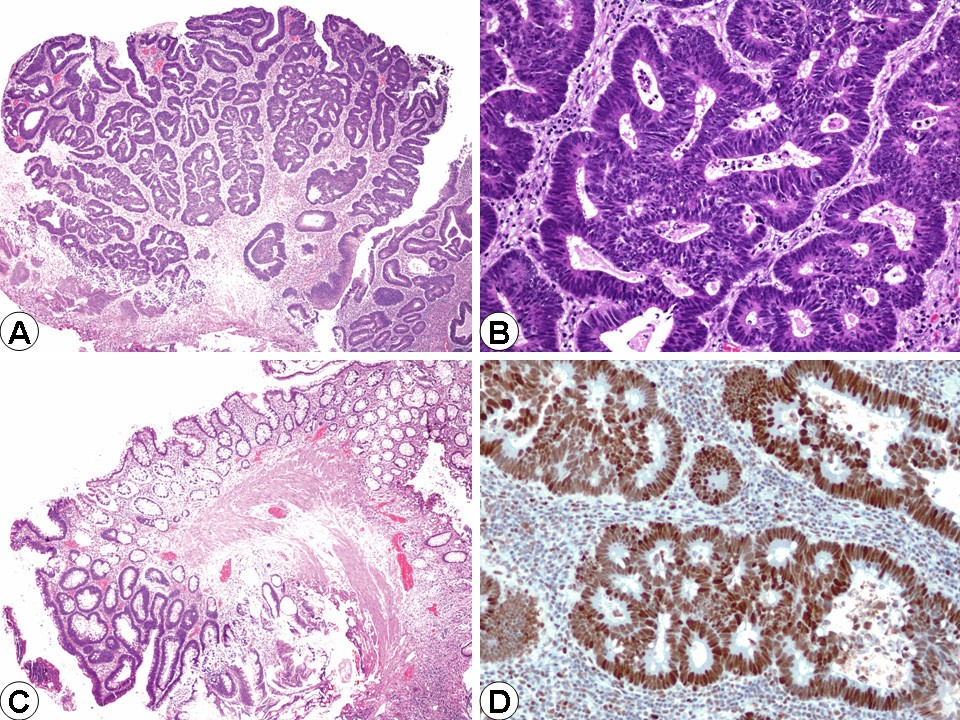 что значит тубулярная аденома low grade
