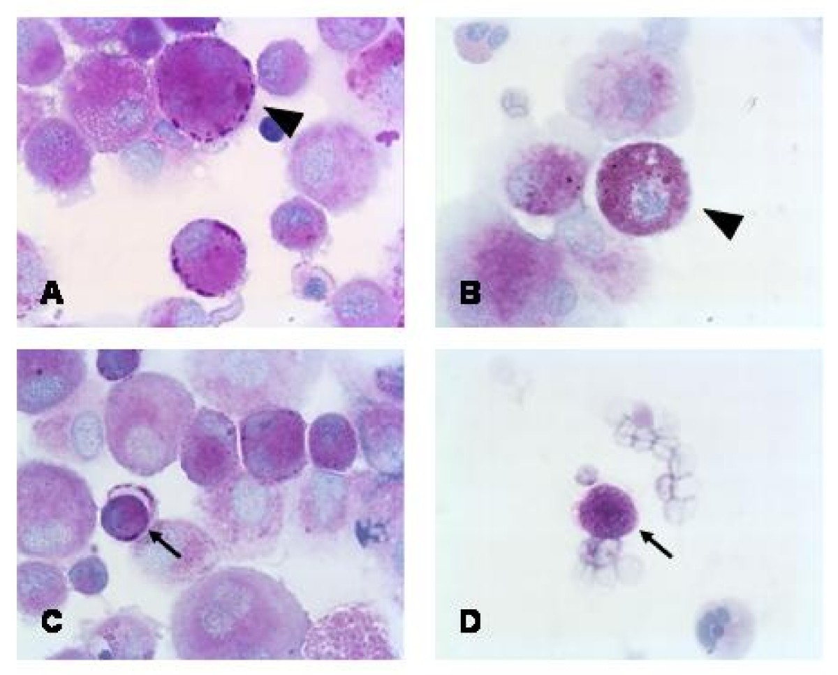 PAS staining of bronchoalveolar lavage cells for differential diagnosis of  interstital lung disease | Diagnostic Pathology | Full Text