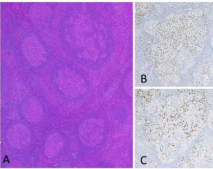 Systemic Igg4 Related Disease With Extensive Peripheral Nerve