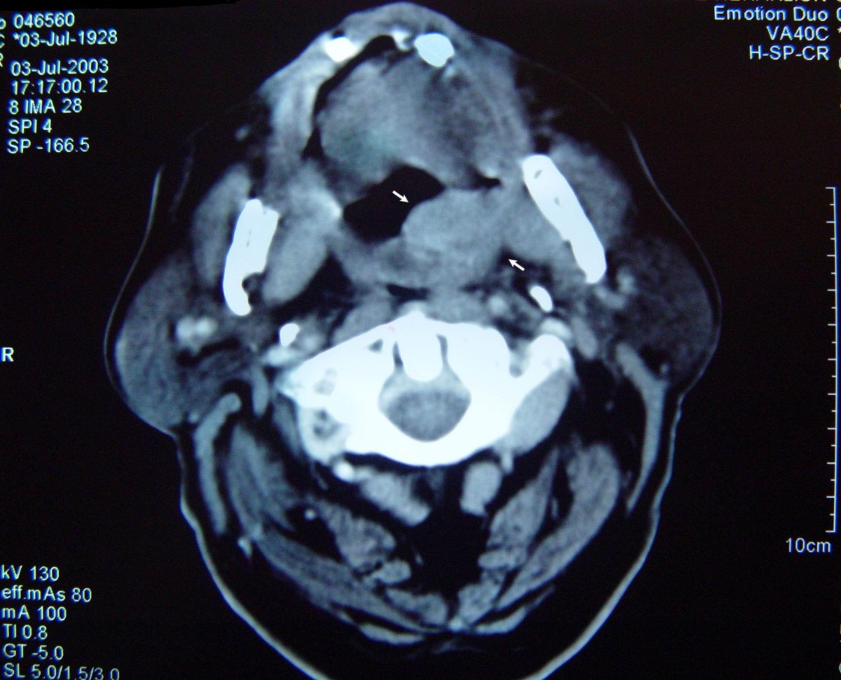 Oral Mucosal Melanoma A Malignant Trap Head And Face Medicine Full Text