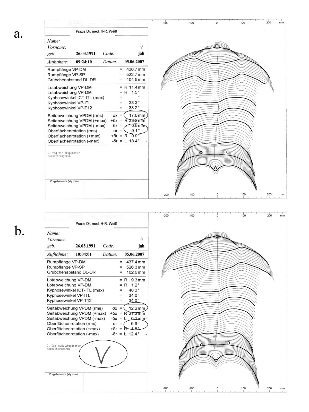 Bourgogne Spiller skak mytologi Acupucture in the treatment of scoliosis – a single blind controlled pilot  study | Scoliosis and Spinal Disorders | Full Text