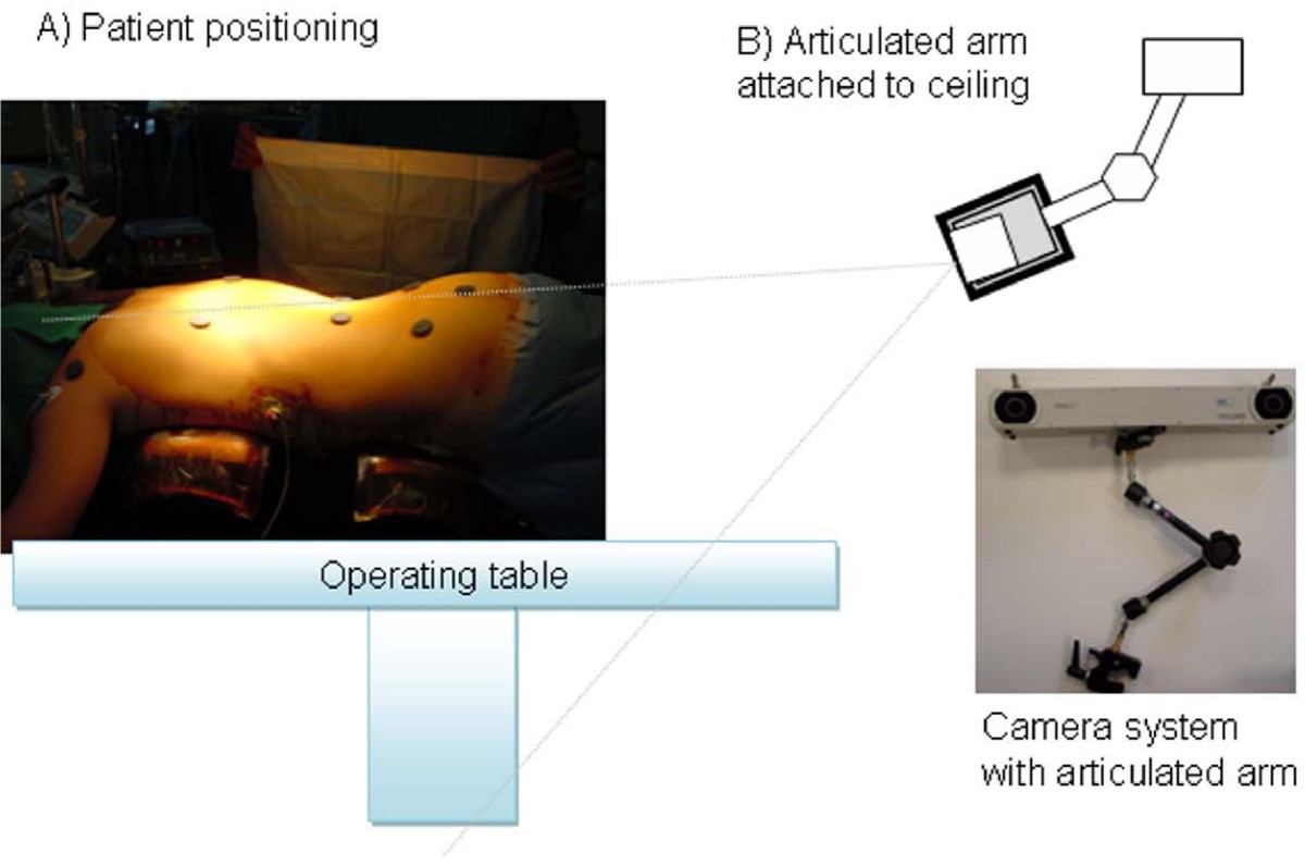 Real Time Noninvasive Assessment Of External Trunk Geometry