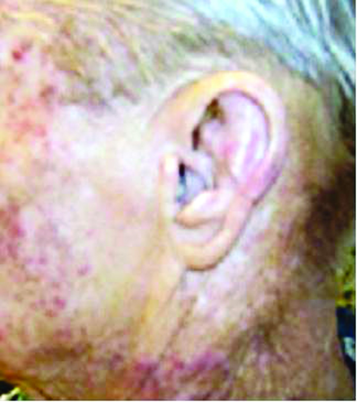 Lack of Cetuximab induced skin toxicity in a previously irradiated