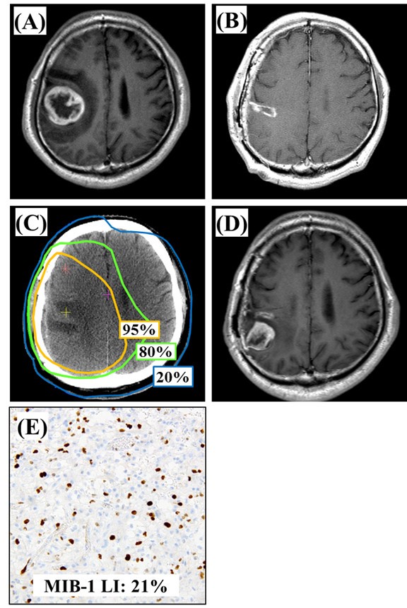 Figure 2 | Patterns of failure after multimodal treatments for high-grade  glioma: effectiveness of MIB-1 labeling index | SpringerLink