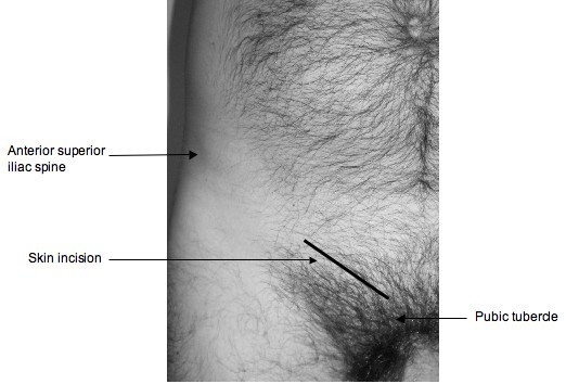 Open femoral hernia repair: one skin incision for all