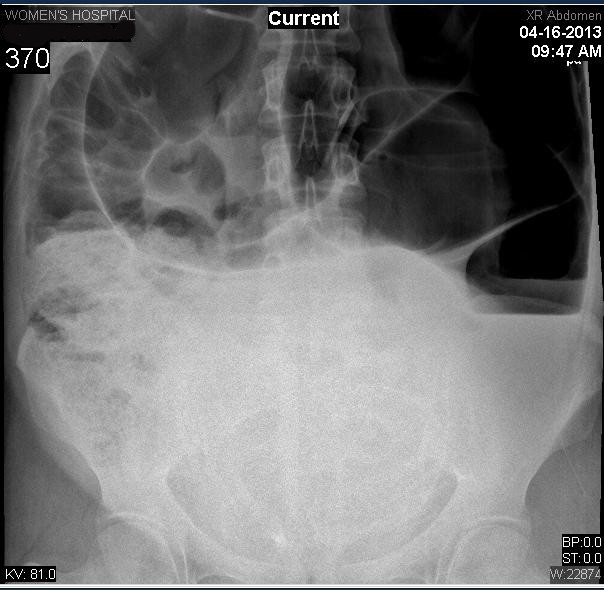 Endoscopic reduction of a volvulus of the sigmoid colon in pregnancy case report and a