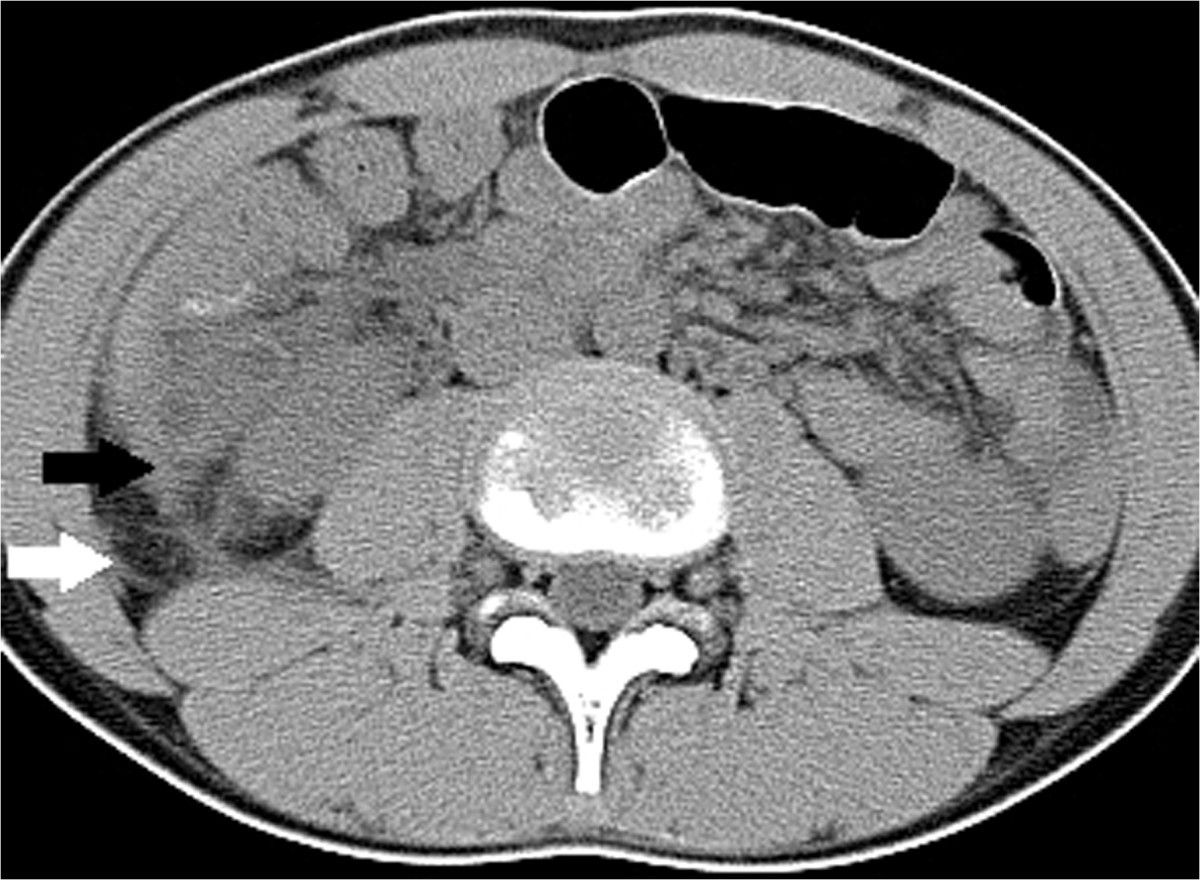 Important CT findings for prediction of severe appendicitis ...